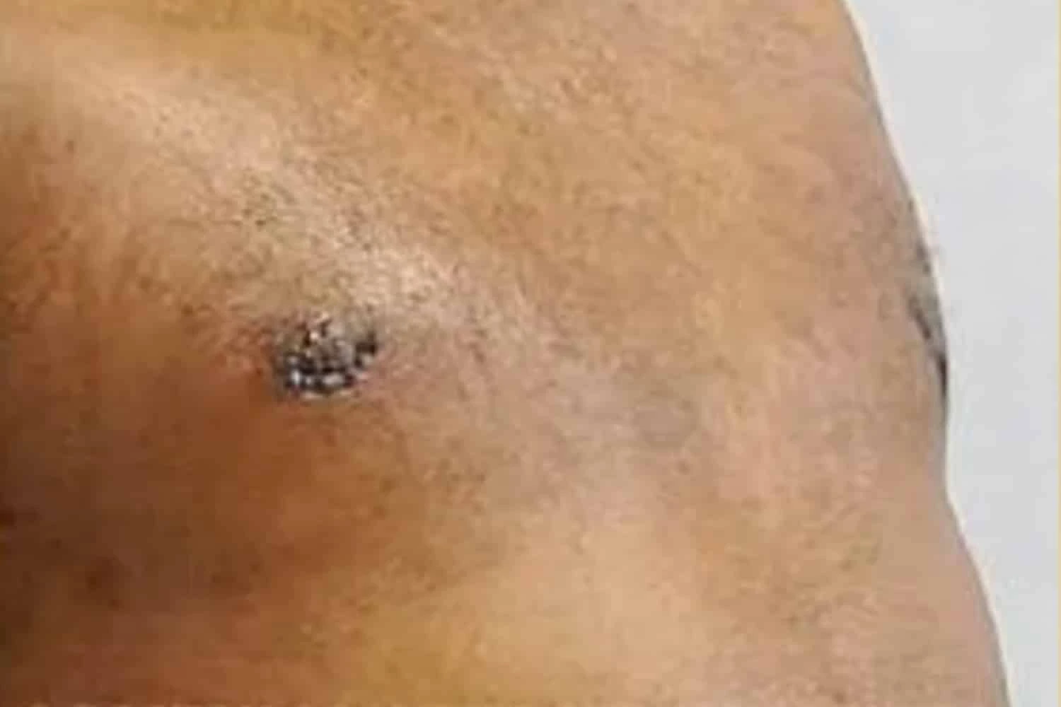 Male chest before body augmentation procedure, showing baseline anatomy