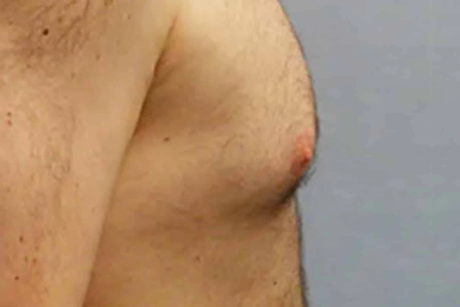Male chest after body augmentation, angled side view