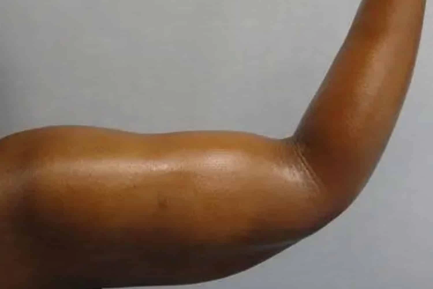 Patient arm showing toned muscle definition after VaserLipo treatment