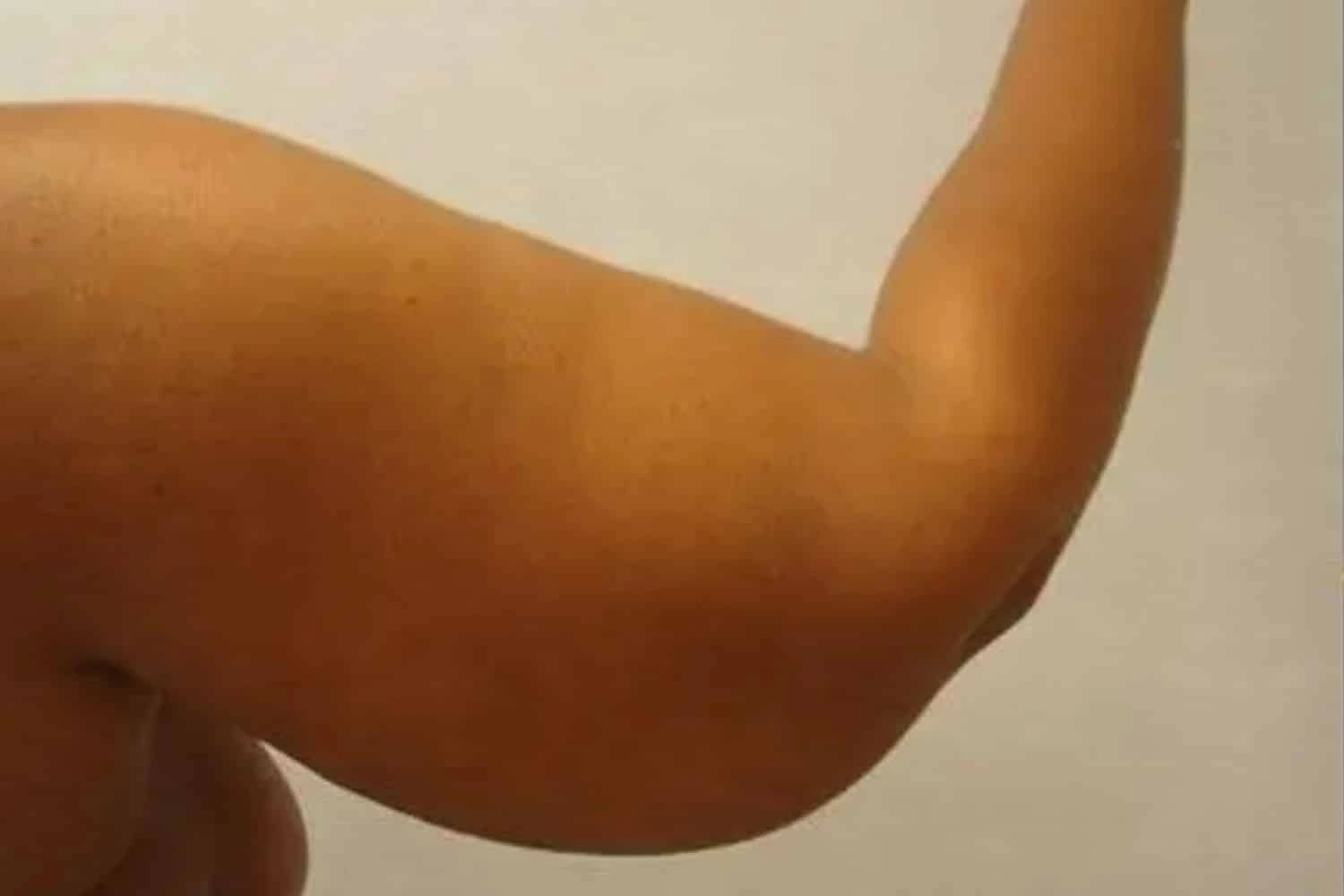 Patient arm showing improved muscle contour after VaserLipo procedure