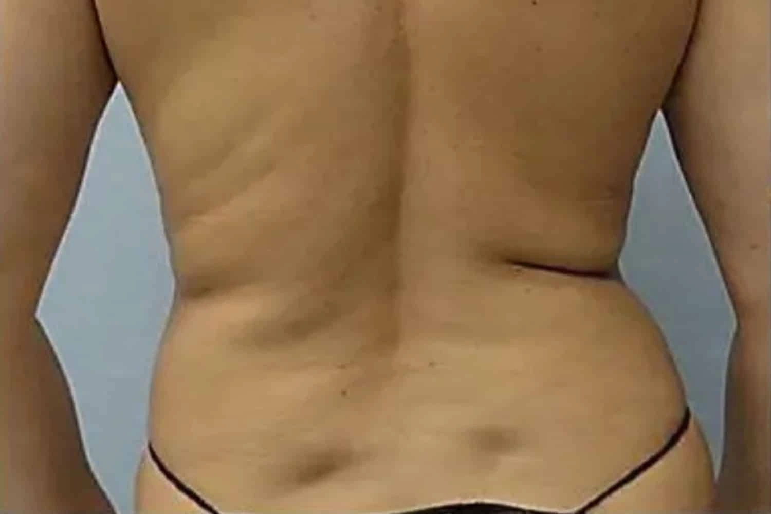 Patient back view after VaserLipo, showing enhanced muscle definition and body sculpting