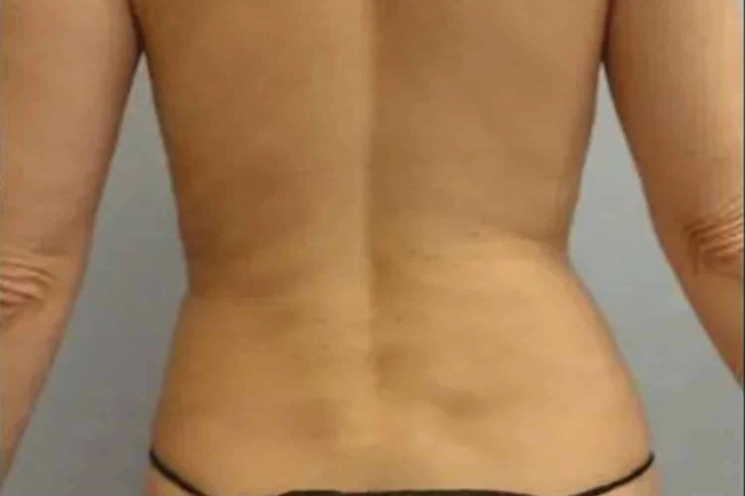 Patient back view before VaserLipo, showing natural body contours
