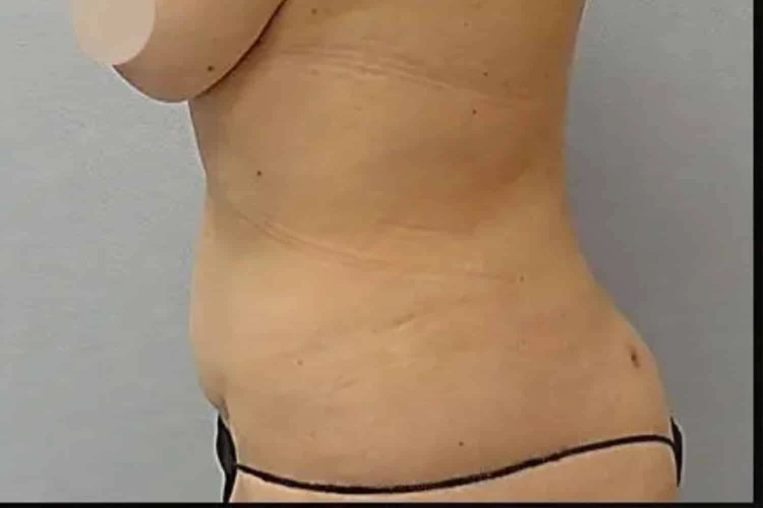 Before Vaserlipo treatment: patient's torso showing fuller abdominal contour
