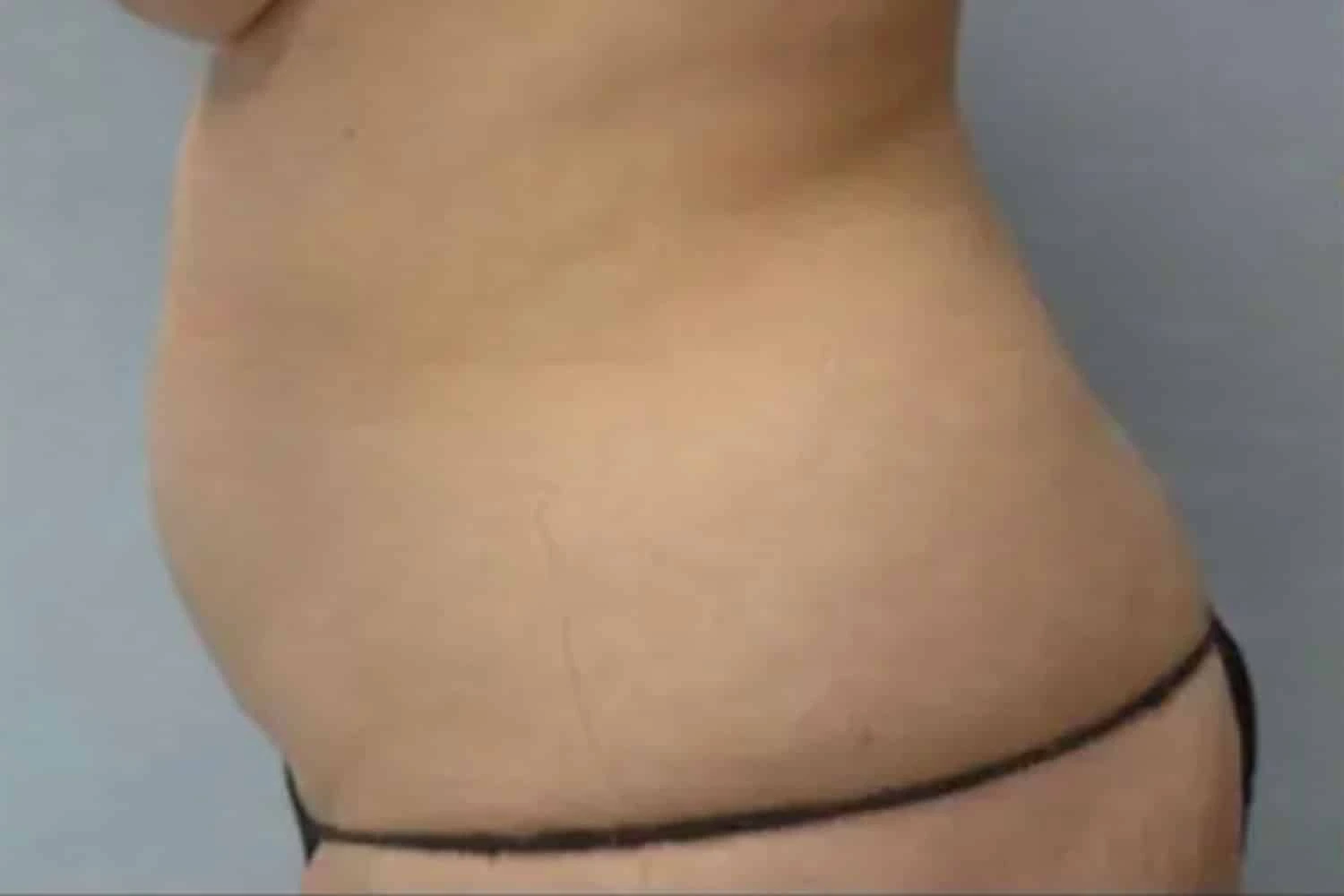 After Vaserlipo treatment: patient's torso showing reduced abdominal contour and improved definition